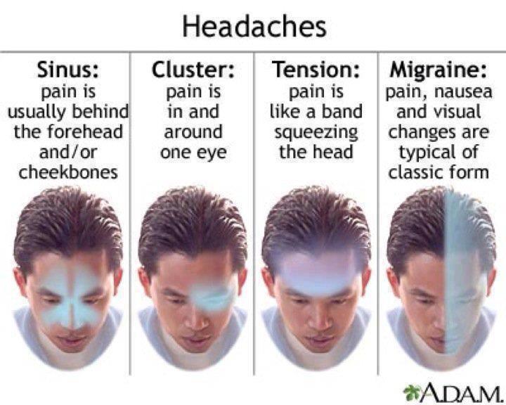 Types of Headaches Types of Headaches,Types of ,Headaches,Migraine,tension,cluster